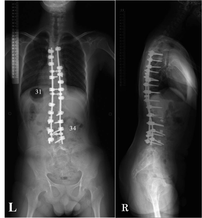 Rubinstein-Taybi syndrome with scoliosis treated with single-stage