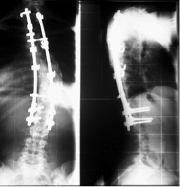 Cotrel-dubousset instrumentation for the correction of adolescent  idiopathic scoliosis. Long-term results with an unexpected high revision  rate | Scoliosis and Spinal Disorders | Full Text