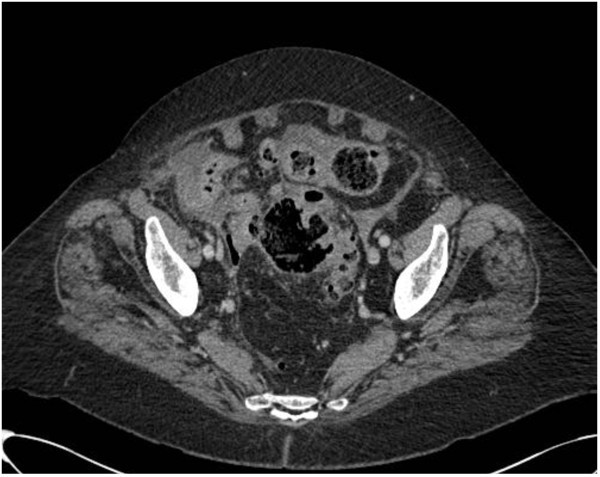 A proposal for a CT driven classification of left colon acute diverticulitis  | World Journal of Emergency Surgery | Full Text