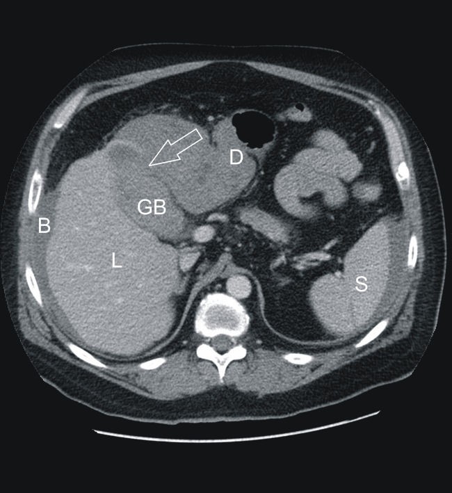 Acute gallbladder perforation with gallstones spillage in a cirrhotic  patient | World Journal of Emergency Surgery | Full Text