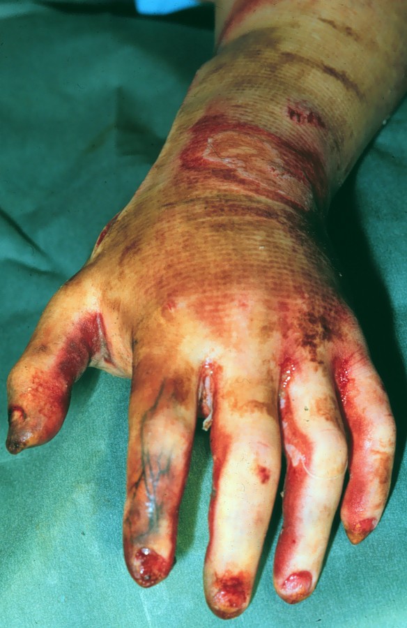 Treatment of burns in the first 24 hours: simple and practical