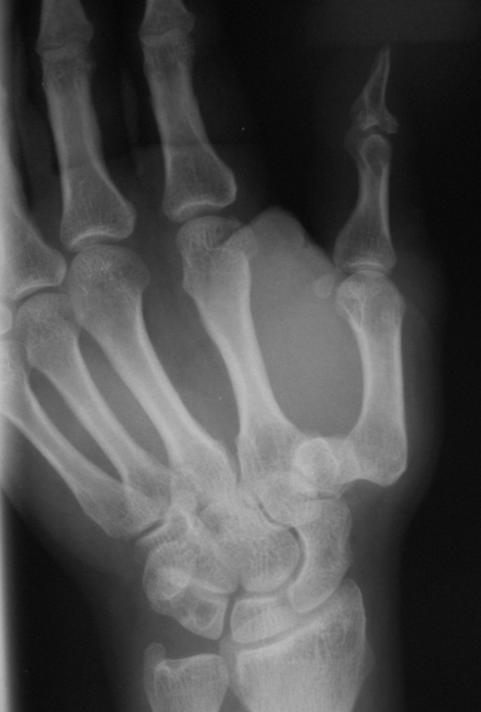 carpometacarpal joint dislocation