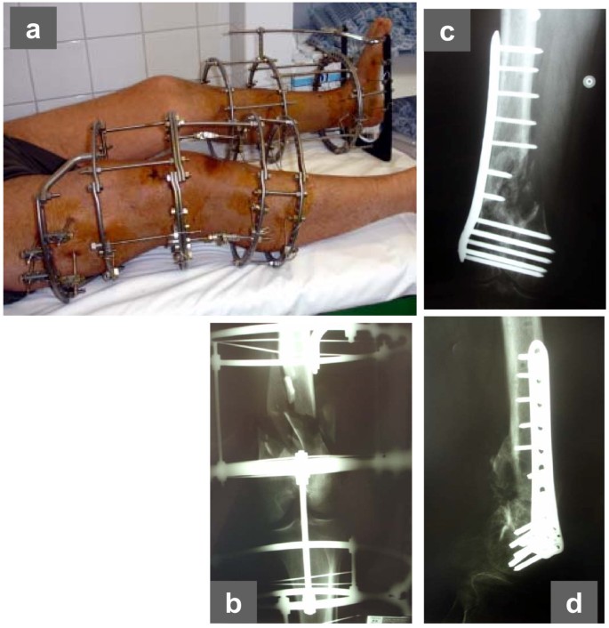 A Novel technique of three-ring Ilizarov fixator frame in gap non-union of  tibia - ScienceDirect