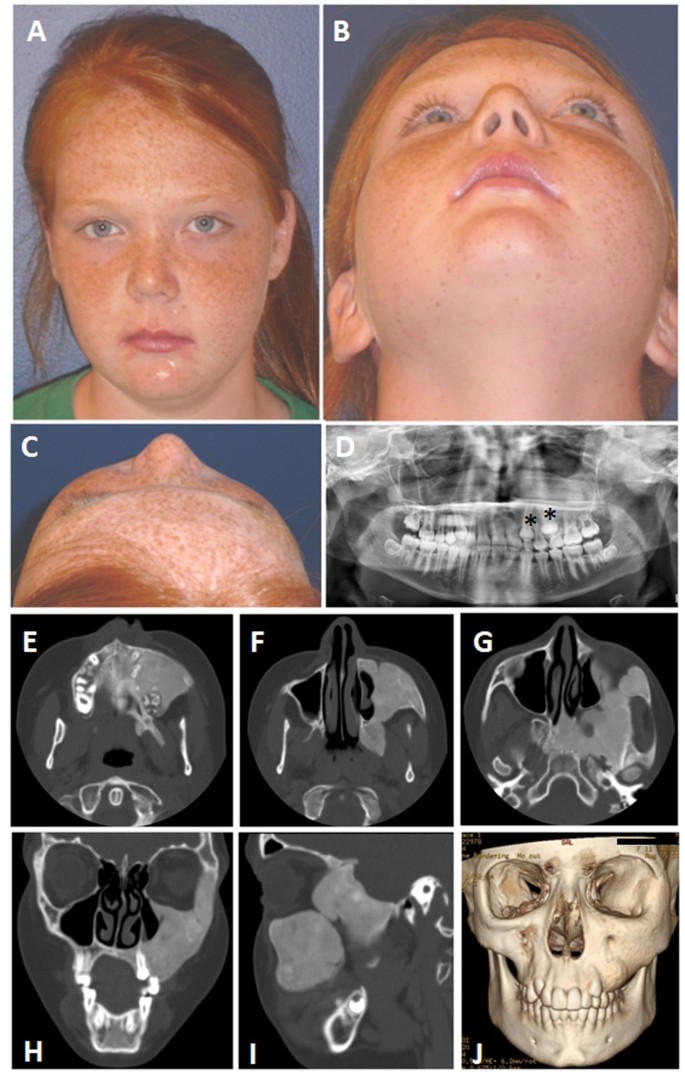 Clinical guidelines for the management of craniofacial fibrous dysplasia |  Orphanet Journal of Rare Diseases | Full Text