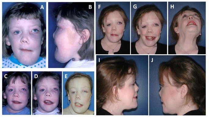 fibrous dysplasia face