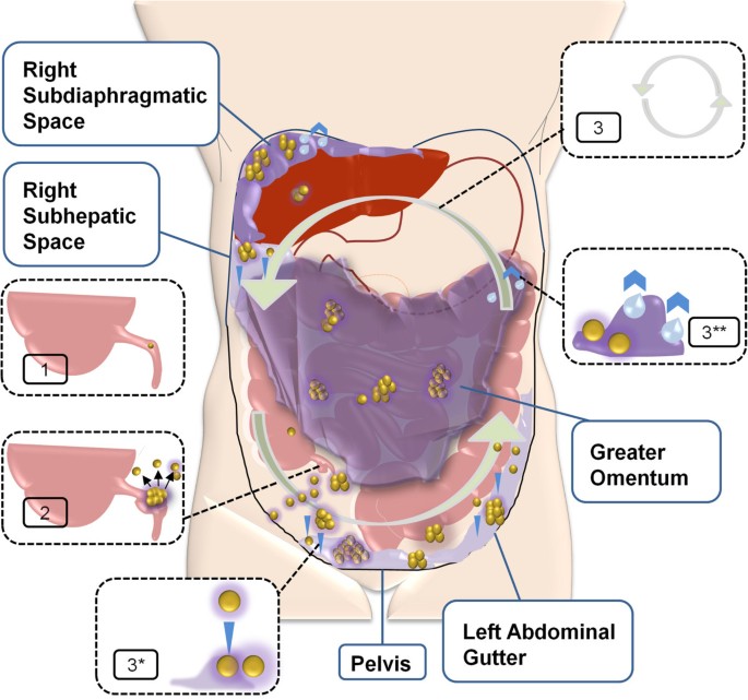 Cancer pseudomyxoma peritoneal. ionut hutanu - „Google“ mokslinčiaus šaltiniai