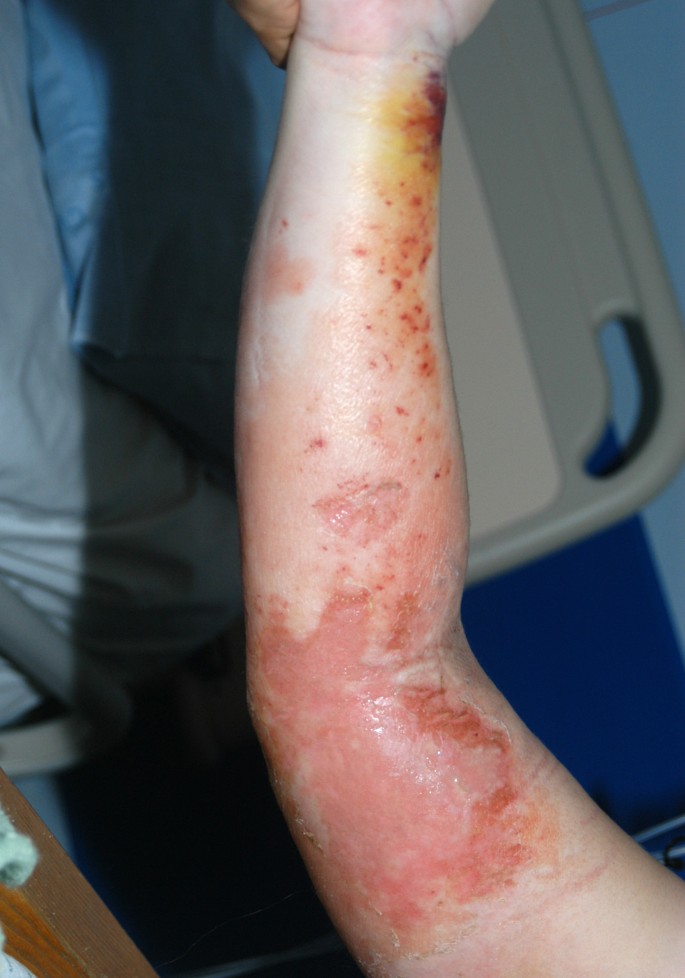 Streptococcal toxic shock syndrome revealed phlegmasia cerulea dolens of  the arm - The Lancet Infectious Diseases