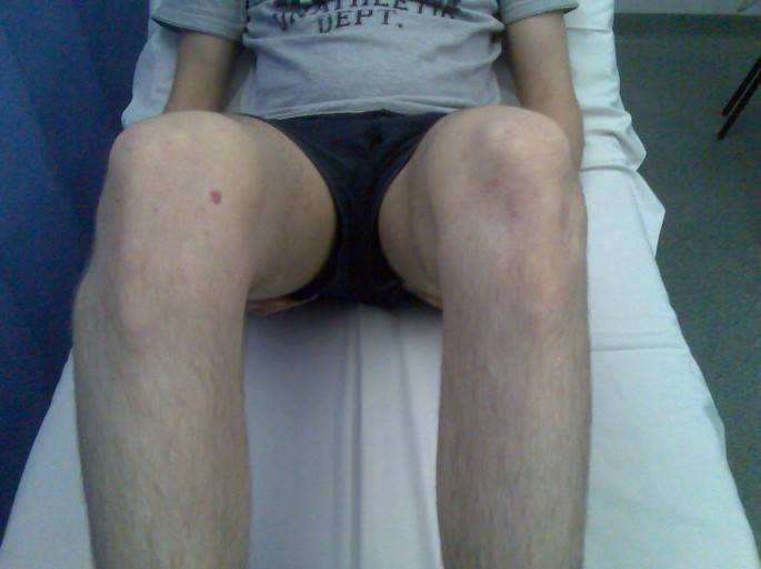 Dislocation of the fibular head in an unusual sports injury: a case report  | Journal of Medical Case Reports | Full Text