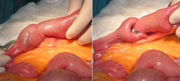 Intussusception of the small bowel secondary to malignant metastases in two 80-year-old people: a case series | Journal of Medical Case Reports | Full Text Intussusception of the small bowel secondary to malignant metastases in two 80-year-old people: a case series | Journal of Medical Case Reports | Full Text