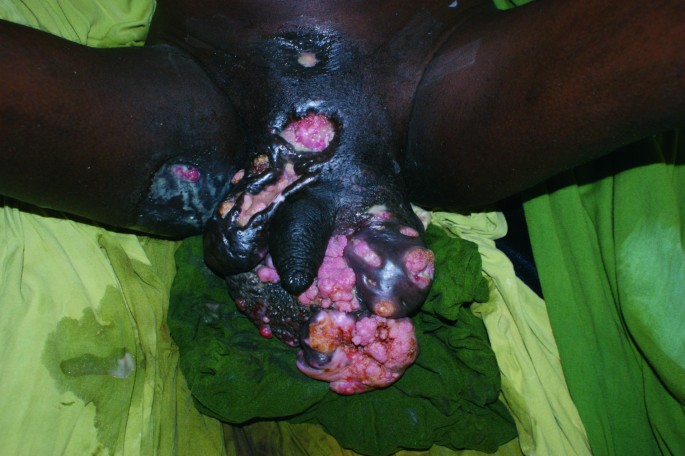 bushke condyloma kezelés