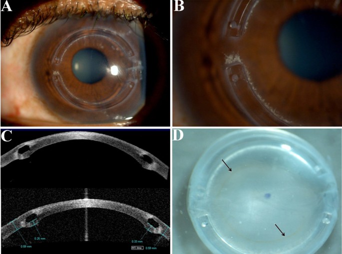 Hypocellular scar formation or aberrant fibrosis induced by an intrastromal corneal  ring: a case report | Journal of Medical Case Reports | Full Text