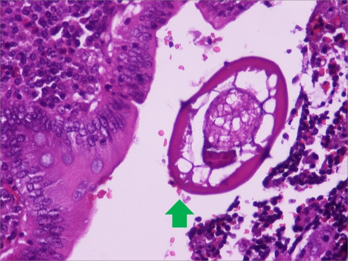 Enterobius vermicularis eosinophilia, Pinworm eosinophilia