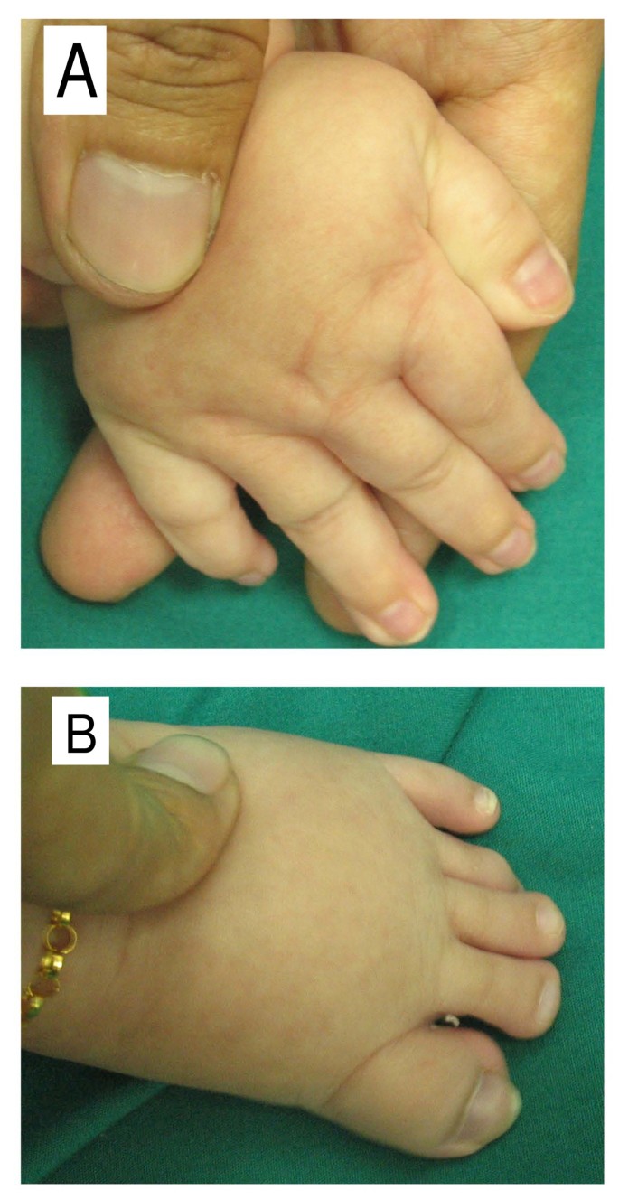 Rubinstein-Taybi syndrome - Atlas of Human Malformation Syndromes