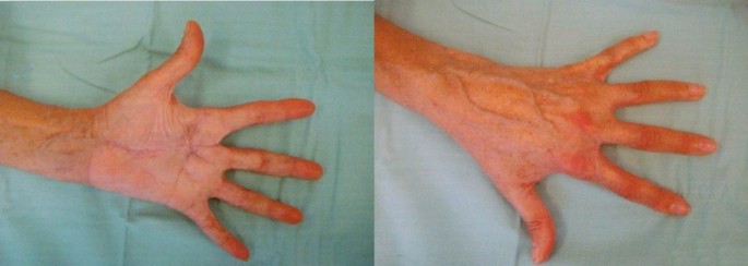 viermi droguri îndepărtate verucile genitale surgitron recenzii
