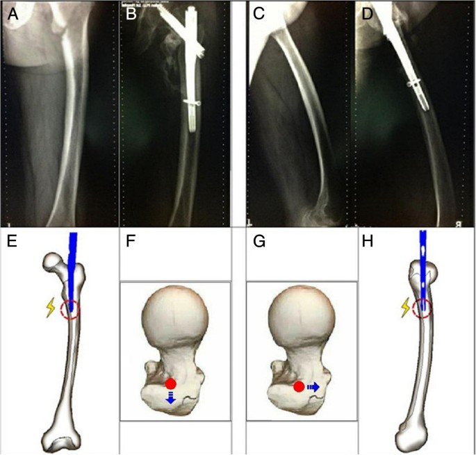 Implantation of INTERTAN™ nail in four patients with intertrochanteric  fractures leading to single or comminute fractures: pitfalls and  recommendations: a case series | Journal of Medical Case Reports | Full Text