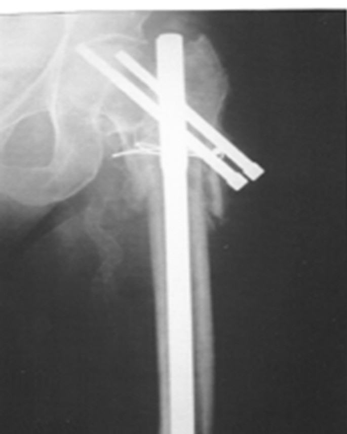 Complex proximal femoral fractures in the elderly managed by reconstruction  nailing – complications & outcomes: a retrospective analysis | Journal of  Trauma Management & Outcomes | Full Text