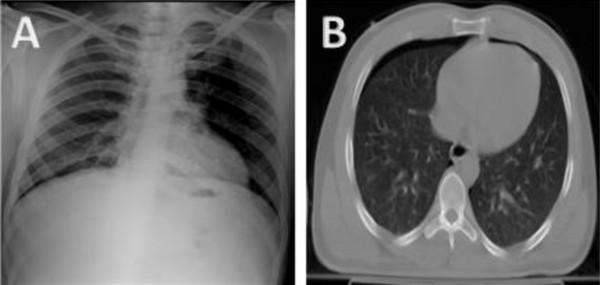 Anteroposterior Chest Radiograph Vs Chest Ct Scan In Early Detection Of Pneumothorax In Trauma Patients International Archives Of Medicine Full Text