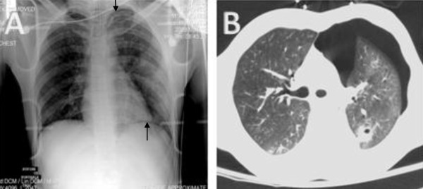 Anteroposterior Chest Radiograph Vs Chest Ct Scan In Early Detection Of Pneumothorax In Trauma Patients International Archives Of Medicine Full Text