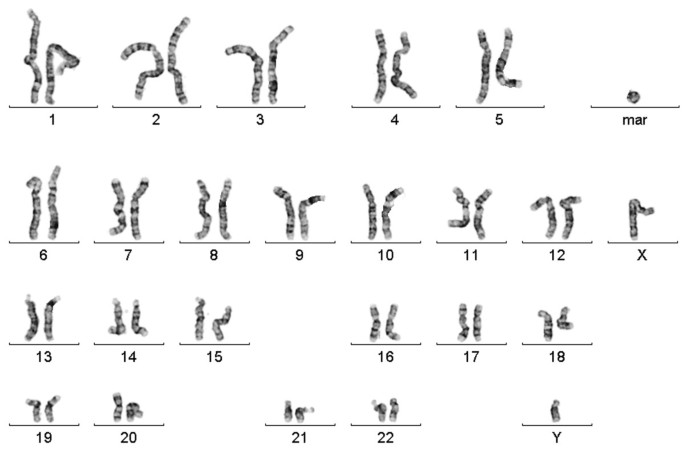 Towards New Approaches to Evaluate Dynamic Mosaicism in Ring Chromosome 13  Syndrome. - Document - Gale Academic OneFile