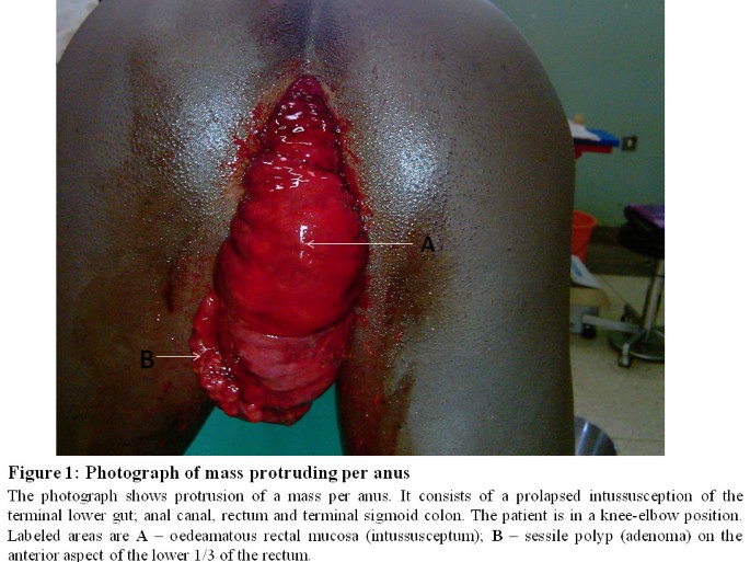 Precipitous intussusception with anal protrusion and complete overt rectal  prolapse presenting with intestinal obstruction and an associated rectal  adenoma in a young man: a case report | BMC Research Notes | Full Text