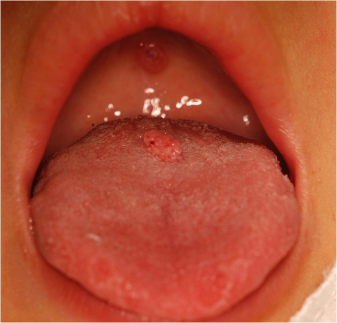 genital warts on tongue removal