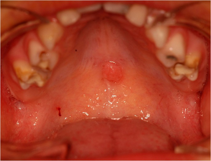 condyloma hpv terápia