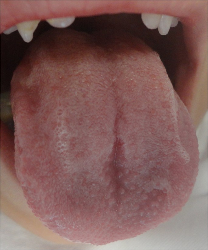 Vestibular papillomatosis on tongue, Papillomatosis of the tongue