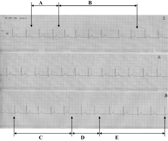 Marked First Degree Atrioventricular Block An Extremely Prolonged