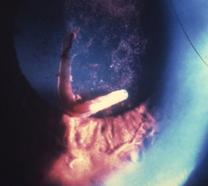 parasite in human eye