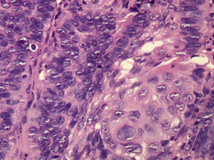 Metatypical Basal Cell Carcinoma A Clinical Review Journal Of