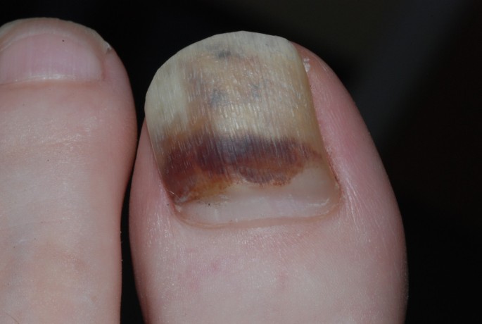 Clinical guidelines for the recognition of melanoma of the foot and nail  unit | Journal of Foot and Ankle Research | Full Text