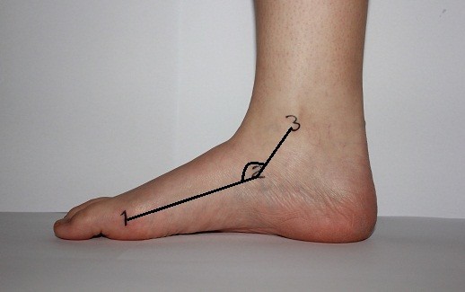 medial longitudinal arch