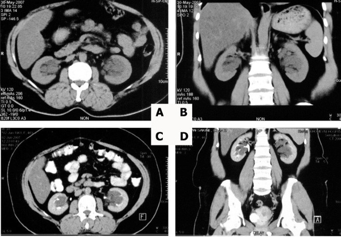 Pdf Bilateral Parapelvic Cysts That Mimic Hydronephrosis In Two Imaging Modalities A Case Report