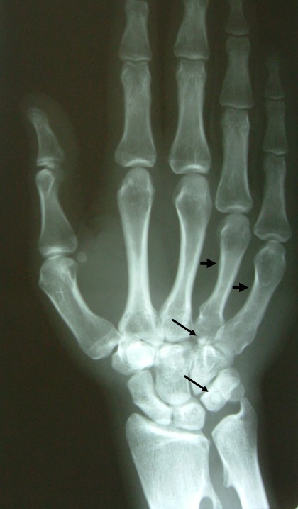 Anatomical variation of co-existence of 4th and 5thshort metacarpal bones,  sesamoid ossicles and exostoses of ulna and radius in the same hand: a case  report | Cases Journal | Full Text