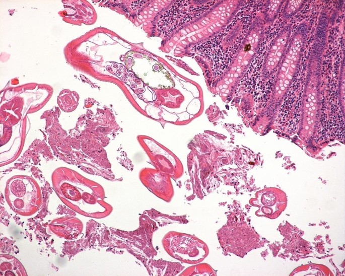 enterobius vermicularis in appendix)