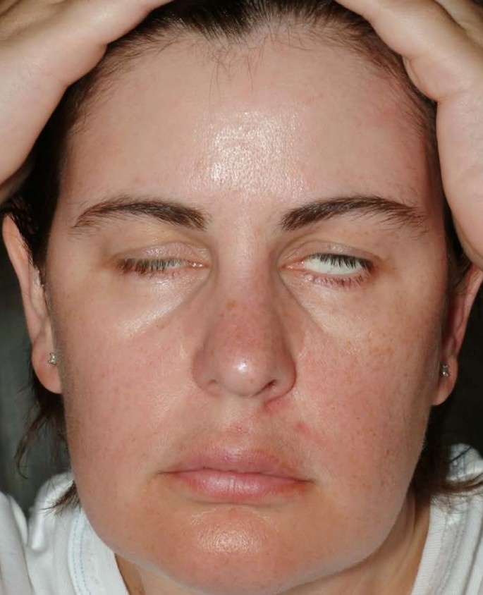 Guillain Barre Syndrome Presenting With Bilateral Facial Nerve Paralysis A Case Report Cases Journal Full Text Guillain Barre Syndrome Presenting With Bilateral Facial Nerve Paralysis A Case Report Cases Journal Full Text