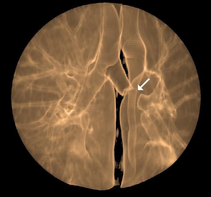 case study on bronchial asthma figure 5