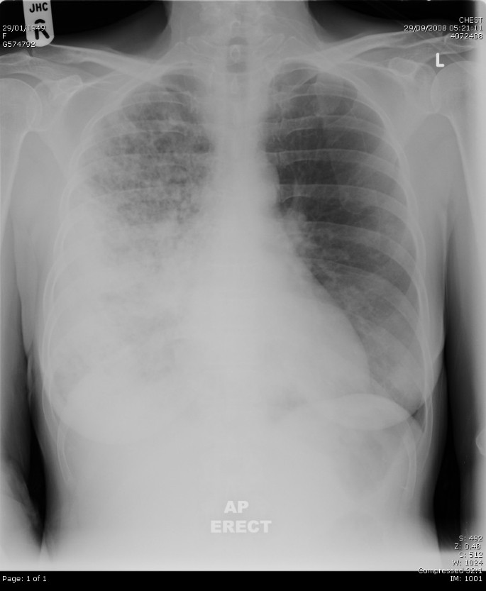 Page chest. Consolidation - right lower Lobe.