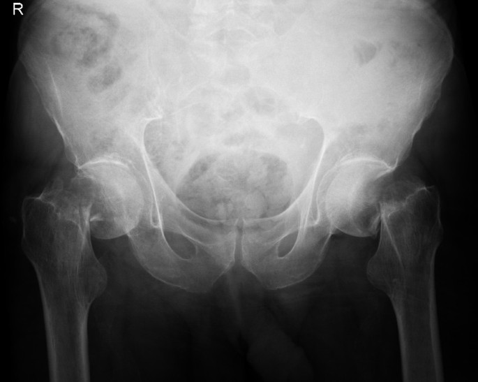 case study fracture neck of femur figure 1