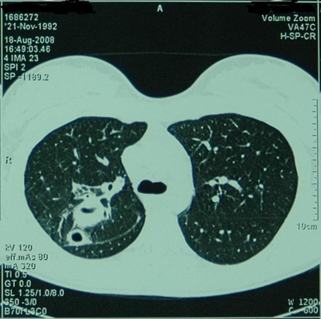 Multiple lung abscesses due to acinetobacter infection: a case report |  SpringerLink