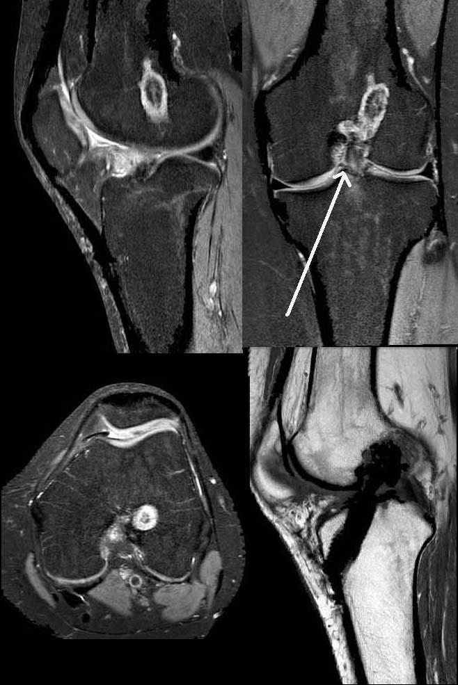 Painful Knee Joint After Acl Reconstruction Using Biodegradable Interference Screws Spect Ct A Valuable Diagnostic Tool A Case Report Bmc Sports Science Medicine And Rehabilitation Full Text
