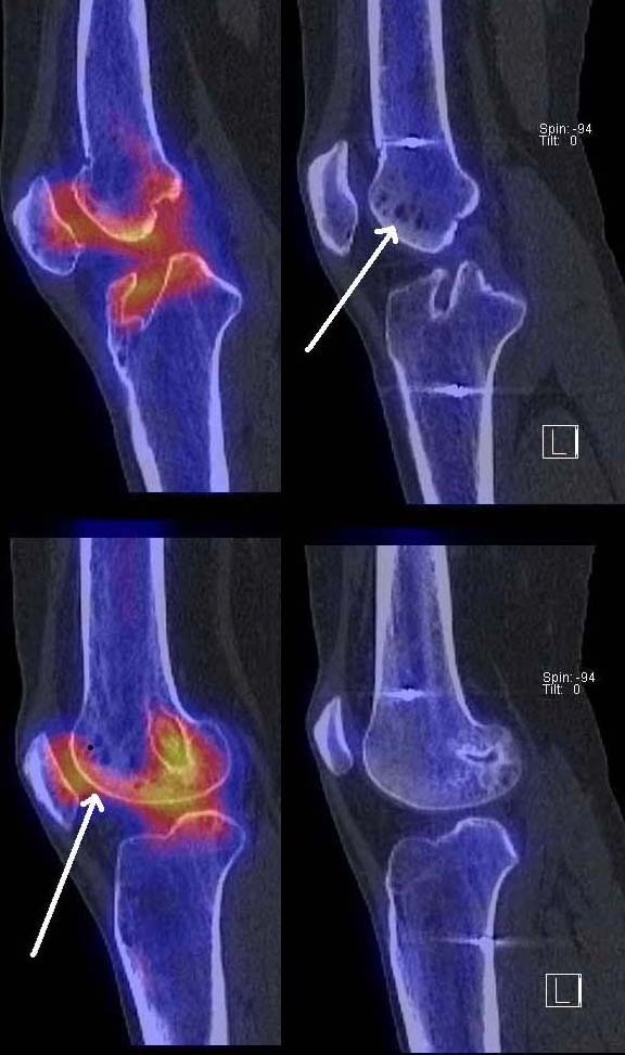 Painful Knee Joint After Acl Reconstruction Using Biodegradable Interference Screws Spect Ct A Valuable Diagnostic Tool A Case Report Bmc Sports Science Medicine And Rehabilitation Full Text Painful Knee Joint After Acl Reconstruction Using Biodegradable Interference Screws Spect Ct A Valuable Diagnostic Tool A Case Report Bmc Sports Science Medicine And Rehabilitation Full Text