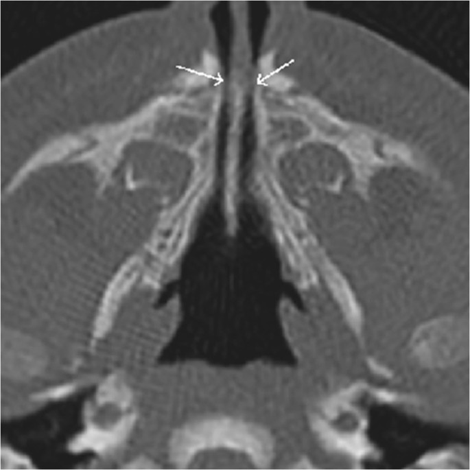 posterior nasal aperture