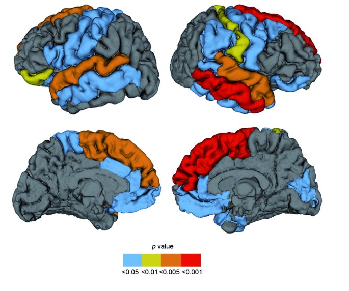 Gyrification, cortical and subcortical morphometry in ...
