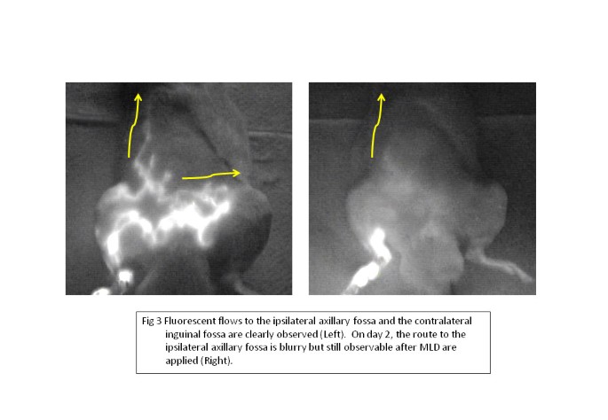 Efficacy of complete decongestive therapy (CDT) on edematous rat limb after  lymphadenectomy demonstrated by real time lymphatic fluid tracing |  SpringerPlus | Full Text