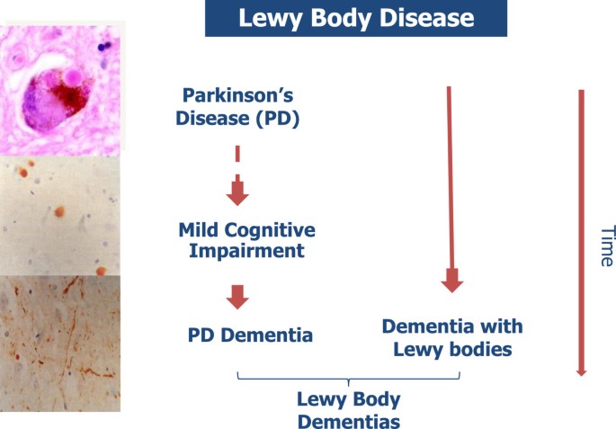 The clinical characteristics of dementia with Lewy bodies and a  consideration of prodromal diagnosis | Alzheimer's Research & Therapy |  Full Text