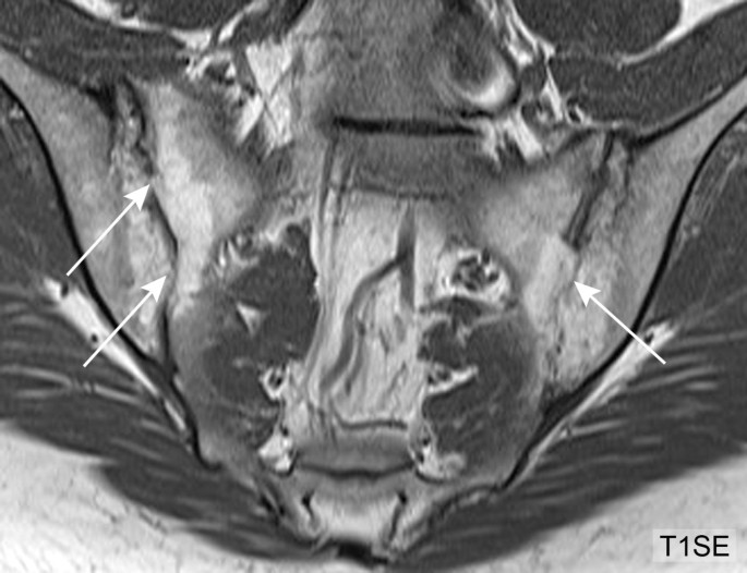 Can erosions on MRI of the sacroiliac joints be reliably detected in  patients with ankylosing spondylitis? - A cross-sectional study | Arthritis  Research & Therapy | Full Text