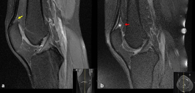 The relationship between quadriceps fat pad syndrome and patellofemoral  morphology: a case–control study | Journal of Orthopaedics and Traumatology  | Full Text