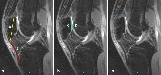 The relationship between quadriceps fat pad syndrome and patellofemoral  morphology: a case–control study | Journal of Orthopaedics and Traumatology  | Full Text