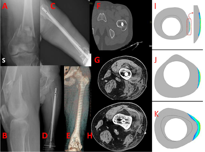 Subtrochanteric fractures after retrograde femoral nailing